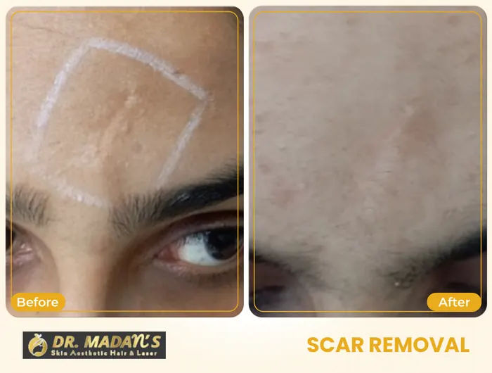 Scar removal before and after result 5 at Dr Madan Aesthetics